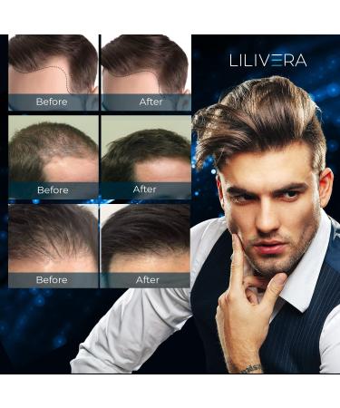 LILIVERA 5% Minoxidil for Men and Women Kit - 2 Fl Oz. - Buy Online on GoSupps.com