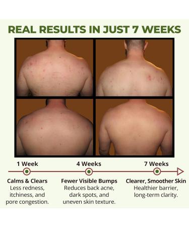 ABERA Folliculitis Body Wash for Men & Women High-Performance Shower Gel with BHA Wild Bitter Melon & Tea Tree 1 Box + Ginseng Anti Dandruff Shampoo Scalp Fungus Treatment Reduce Itching (Set 2) D. Set 2 - Buy Online on GoSupps.com