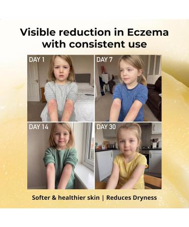 Sven's Island Miracle Manuka - Natural Skin Balm (1.94oz) | Steroid-Free Eczema Cream & Miracle Balm | Dermatologist Approved | With Manuka Leaf Oil | For Dry Sensitive Skin | Made in New Zealand - Buy Online on GoSupps.com