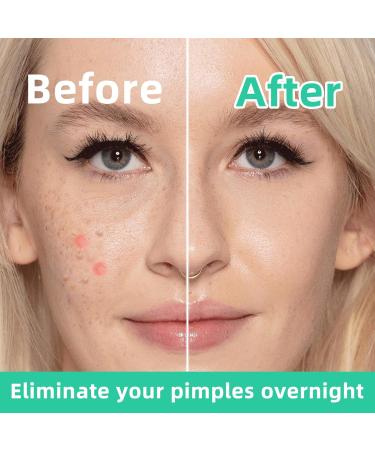 Meegoo Original Hydrocolloid Acne Pimple Patches - 3 Packs (108 Stickers) for Zits & Blemishes | Best Spot Stickers for Clear Skin - Buy Online on GoSupps.com