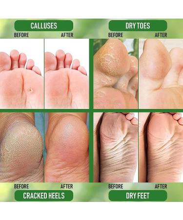 Urea 40% Foot Cream - Urea Cream for Feet - Foot Cream for Cracked Heels and Dry Skin - Cracked Heel Repair Cream with Hyaluronic Acid and Aloe Vera - Foot Cream for Very Dry Feet - Buy Online on GoSupps.com
