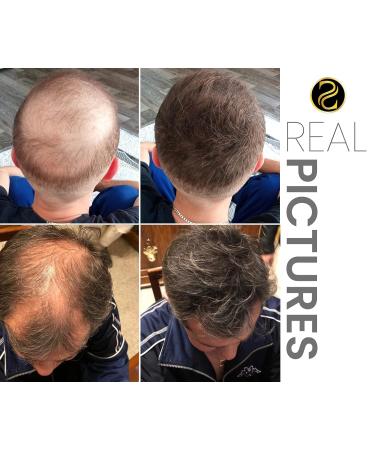 Buy Illusya Scatter Hair Fibers - Premium Hair Sealing for Full Hair in Seconds (3rd Brown) - Perfect for Thin Hair - Fast International Shipping - Buy Online on GoSupps.com