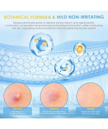 AUSLKA Anti-Pimple Serum Vials 10% Salix Alba (Willow) Bark Extract Serum for Oily/Pimple Skin | Oil Control & Eliminate Pimple | Single-Use Vials(1.5ml*30) - Buy Online on GoSupps.com