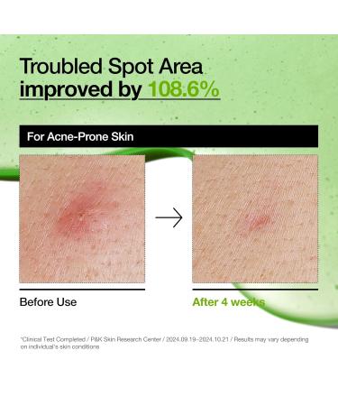 Anua Azelaic Acid 10 Hyaluron Redness Soothing Serum Facial Serum for Sensitive skin Hyaluronic Acid Niacinamide Spot Care Natural Color Vegan Korean Skincare (30ml/ 1.01 fl oz.) - Buy Online on GoSupps.com