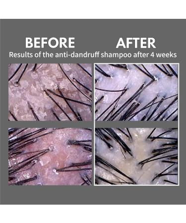 LA DOR Anti-Dandruff Shampoo for Oily Scalp - Soothing 16.9 fl.oz. Formula Cleanses Dead Skin & Alleviates Itching | Buy Internationally - Buy Online on GoSupps.com