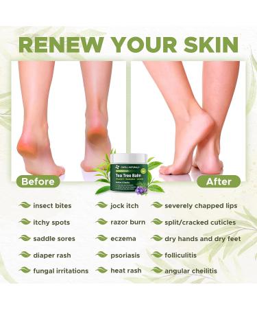 OWELL NATURALS Tea Tree Balm Oil 2oz - Soothes Acne Itchy Skin & Rashes - Vitamin E Paraben-Free Multi-Use for Insect Bites & Burns - Buy Online on GoSupps.com
