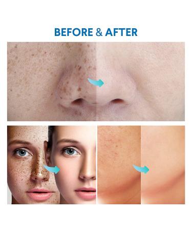 Razor Bump Stopper & Dark Spot Remover: Ingrown Hair Treatment for Men & Women - Buy Online on GoSupps.com