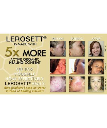 LEROSETT Botanical Acne Cleanser - Gentle Foaming Gel Face Wash with 2% Salicylic Acid, 60% Aloe Vera - Non-Drying, Vegan Formula for Acne Prone & Sensitive Skin - 6.7 oz - Buy Online on GoSupps.com