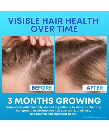 Biotin Gummies 10 000mcg with Collagen - 23-in-1 Hair Growth Gummies for Women & Men - Hair Skin and Nails Gummies with Keratin & Saw Palmetto - Sugar Free Non-GMO Blueberry 90 Count 90 Count (Pack of 1) - Buy Online on GoSupps.com