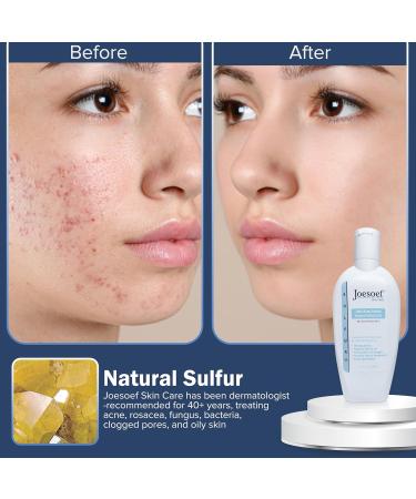 JOESOEF SKIN CARE Sulfur Soap for Acne Pharmaceutical Grade Dermatologists Approved for Acne Rosacea. Sulfur Acne Treatment for Skin Care Daily Routine. (2pack) - Buy Online on GoSupps.com
