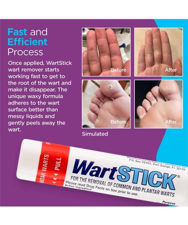 WartStick Maximum Strength Salicylic Acid Solid-Stick Wart Remover 0.2 Oz - Buy Online on GoSupps.com