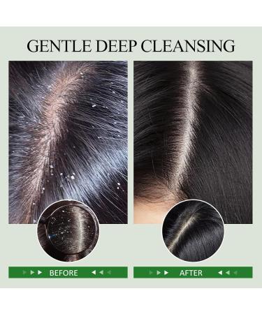 SHVYOG Rosemary Scalp Scrub | Exfoliating Hair Treatment for Build Up | Nourishing Detox Scalp Exfoliator with Massager | 6.76 oz - International Shipping Available - Buy Online on GoSupps.com