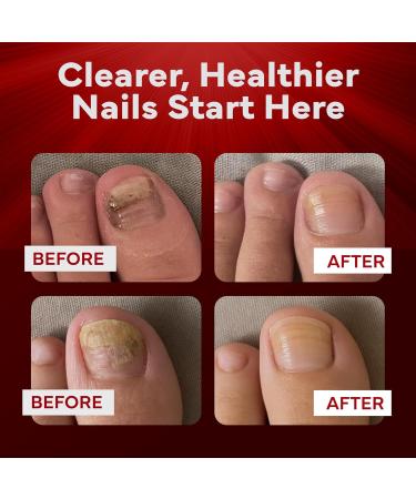 EMUAIDMAX Nail Fungus Treatment Ointment Powerful Natural Nail & Toenail Fungus Treatment for Resistant Fungal Infections Reduces Itching & Discomfort On-The-Go Size 0.35oz 2 Pack 0.35 Fl Oz (Pack of 2) - Buy Online on GoSupps.com