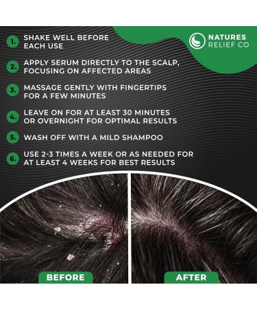 Natures Relief Co Itchy Scalp Treatment Serum - Instant Itch Alleviation | Dry Scalp Treatment - 100% Natural Ingredients - 50ml - Buy Online on GoSupps.com
