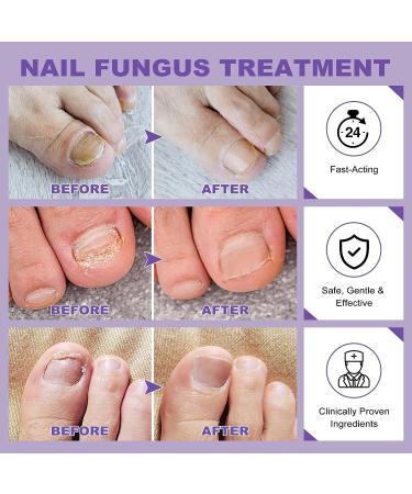 Extra Strength Toenail Fungus Treatment - Nail Repair for Damaged Nails - Fungal Nail Renewal 1oz - Buy Online on GoSupps.com