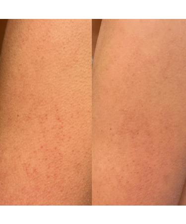 Isle of Paradise Confidently Clear Body Cleanser Acne Body Wash With Lactic Salicylic Mandelic & Polyglutamic Acids to Clear Breakouts Hydrates For Smooth Skin Vegan 11.15 fl. Oz - Buy Online on GoSupps.com