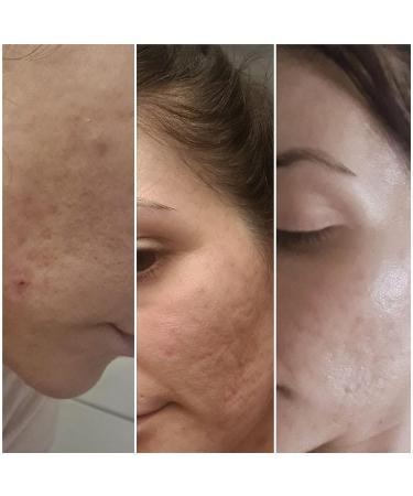 Madecassol Centella Asiatica Cicaplast Face Cream 40g - Scar Healing Gotucream - Buy Online on GoSupps.com