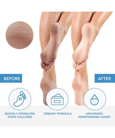 ForPro Premium Callus No More! Callus Remover - Fast-Acting Formula - 4 oz - Buy Online on GoSupps.com
