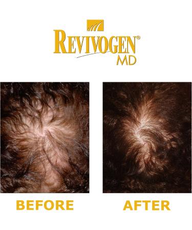 REVIVOGEN MD Scalp Therapy | Natural Hair Loss Solution for Fine & Thinning Hair - International Shipping - Buy Online on GoSupps.com