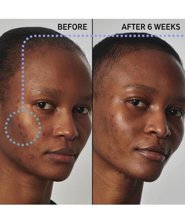 Buy The INKEY List SuperSolutions Niacinamide 20% Serum - Enhance Skin Texture Minimize Pores & Balance Oil - 1.01 fl oz - International Shipping Available - Buy Online on GoSupps.com