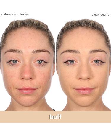 Almay Clear Complexion Acne Foundation Makeup - Lightweight Medium Coverage with Salicylic Acid - Hypoallergenic, Fragrance-Free for Sensitive Skin - 200 Buff, 1 fl oz - Buy Online on GoSupps.com