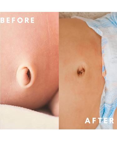 Twins Dream Baby Button Shaper Plug - Works with Baby Belly Band for Hernia - Umbilical Hernia Belt Baby | Cone Shape - Buy Online on GoSupps.com