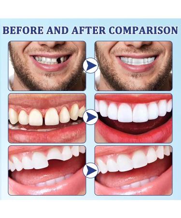 Tooth Glue & Repair Kit | Make Your Own Dentures & Fillings | Temporary Tooth Solutions - Buy Online on GoSupps.com