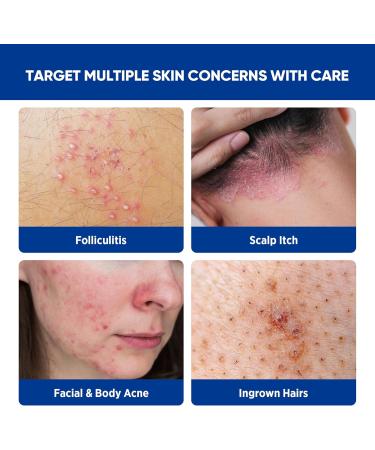 Folliculitis & Acne Treatment Cream Salicylic Acid & Herbal Extracts for Scalp Face Body & Back Soothes Irritated Skin Redness & Itch Relief 100g (Pack of 1) 3.4 Fl Oz (Pack of 1) - Buy Online on GoSupps.com
