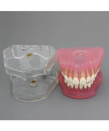Dental Implant Teeth Model - Standard Study and Teaching Tool with Removable Teeth - Buy Online on GoSupps.com