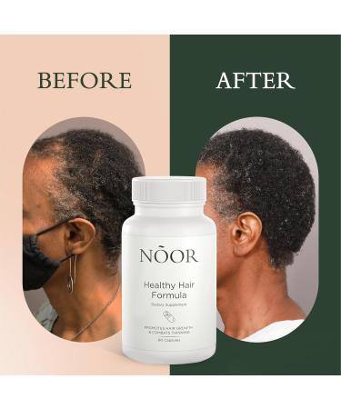 NOOR HAIR Growth Supplement | Healthy Hair Formula for Thick Fast Regrowth | Non-GMO Gluten-Free Vitamins for Women's Hair Loss - 30 Day Supply - Buy Online on GoSupps.com