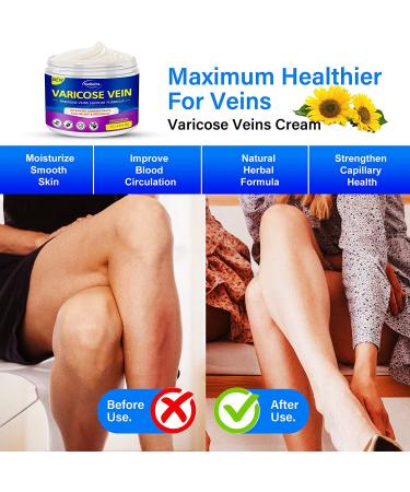 Varicose Veins Cream - Effective Treatment for Legs | Strengthen Capillaries, Improve Circulation | Relief Phlebitis Angiitis Inflammation | 1.7 Fl Oz - Buy Online on GoSupps.com