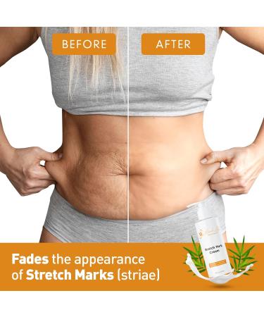 ML Delicate Beauty Stretch Mark Cream & Belly Butter - Advanced Skin Repair & Scar Treatment for All Skin Types - 4 Oz - Buy Online on GoSupps.com