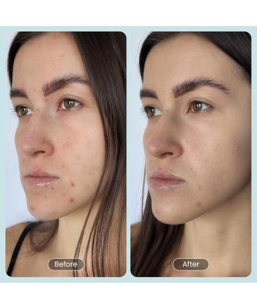 Beautiste 30 DAY MIRACLE BHA 20% Peeling Solution - Clinical Strength BHA Liquid Exfoliant for Clogged Pores Wrinkles & Blackhead Remover - Salicylic Acid Serum & Chemical Exfoliant for Face Peel 1oz - Buy Online on GoSupps.com