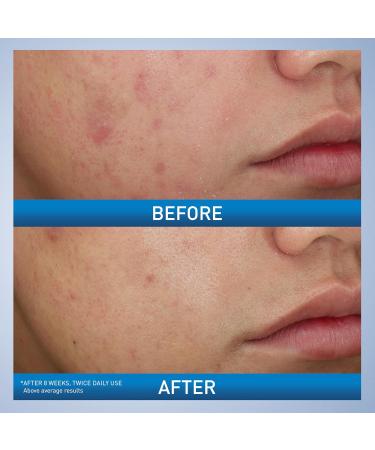 CeraVe Acne Foaming Cream Wash - 10% Benzoyl Peroxide Acne Cleanser Hyaluronic Acid & Niacinamide | Treats Pimples Blackheads & Body Acne - 5 Oz - Buy Online on GoSupps.com