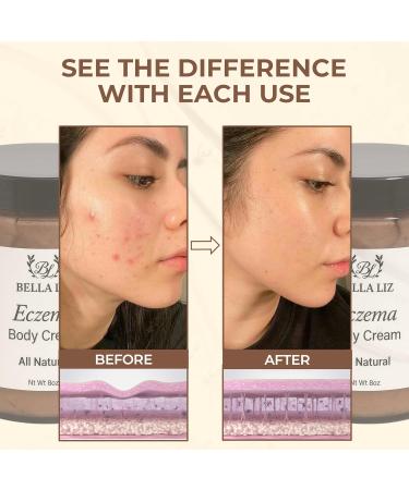 BELLA LIZ Eczema Cream 8oz - Soothing Relief for Dry Irritated Skin Hydrating & Healing Formula All-Natural Ingredients Perfect for Sensitive Skin & Daily Moisturizing - Buy Online on GoSupps.com
