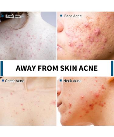 Acne Treatment Soap Bar with Salicylic Acid | Antifungal Medicated Soap for Body Face & Back | Natural Essential Oil Dark Spot Remover - Buy Online on GoSupps.com