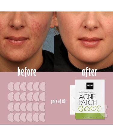 Hydrocolloid Large Acne Patches - 80 Pieces for Cheek & Chin | Conceal Breakouts & Reduce Pimples & Blackheads | International Shipping Available - Buy Online on GoSupps.com