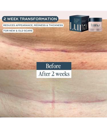 Natural Scar Gel - The Repair Treatment 50ml | Acne Repair Stretch Marks & Dark Spot Reducer | Vegan Hypoallergenic Silicone-Free - Buy Online on GoSupps.com