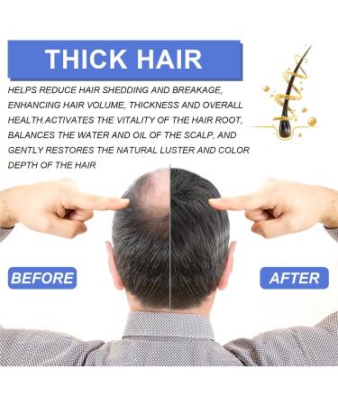 KOAHDE Hair Regrowth Foam for Men Hair Regrowth Spray Foam Hair Growth Foam Anti Hair Loss Foam Thinning Hair Foam for Men Hair Regrowth Treatment for Men Hair Growth Serum for Men Hair Loss Serum - Buy Online on GoSupps.com