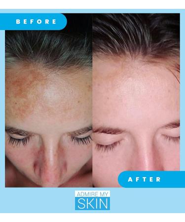 Admire My Skin Dark Spot Corrector Serum + Retinoid Cream Set - Buy Online on GoSupps.com