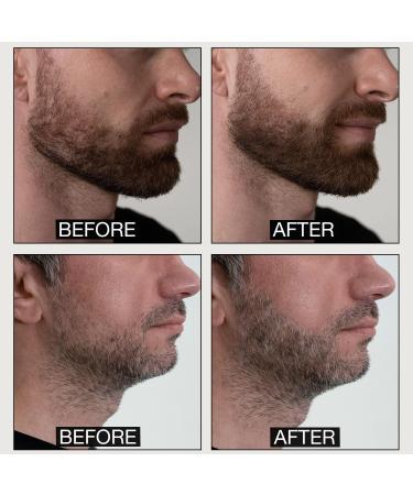 rouleau barbe pour une croissance vigoureuse de la barbe | Dermaroller pour la croissance et les soins de la barbe | derma Beard Roller 0.5mm 540 needles microneedling | Stimuler & acc l rer - Buy Online on GoSupps.com