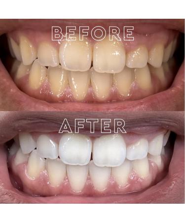 MOON Teeth Whitening Bundle Platinum Express Dissolving Strips & Mint Whitening Pen with Essential Oils Peroxide-Infused Travel Kit for Bright Smile & Sensitive Tooth Care - Buy Online on GoSupps.com