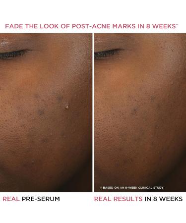 IT Cosmetics Bye Bye Breakout Acne Treatment Serum | 2% Salicylic Acid | Reduce Pimples in 3 Days | Fades Post-Acne Marks in 8 Weeks | 1 fl oz - Buy Online on GoSupps.com