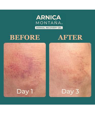 Arnica Gel 7oz - Soothe Bruises with Aloe & Calendula | Arnica Bruise Cream for Face & Body - International Shipping Available - Buy Online on GoSupps.com