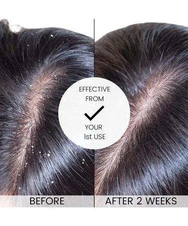 Alevai Stem Cell Anti Dandruff Shampoo - Itchy Scalp Treatment - 2% Pyrithione Zinc - Sulfate-Free - Vegan - 16 oz - Buy Online on GoSupps.com