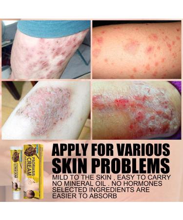 G-SHOTOY Revitaskin Eczema Cure Cream - Relief and Treatment for Adults with Psoriasis - Healthy Skin Treatment (2pcs) - Buy Online on GoSupps.com