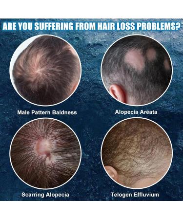 Xionghonglong Hair growth shampoo shampoo for men 100ml Shampoo against hair loss Promotes hair growth Strengthens the hair roots Cleans and cares for the scalp Reduces hair breakage and hair loss - Buy Online on GoSupps.com