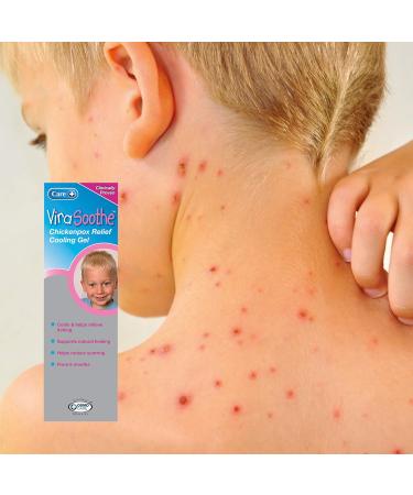 Care ViraSoothe Chickenpox Relief Cooling Gel 75g - Soothes & Cools Skin | Pack of 1 - Buy Online on GoSupps.com