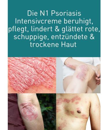 N1 Psoriasis Intensive Cream 100ml - Soothing Eczema & Neurodermatitis Treatment for Red Scaly Inflamed Skin - Relieves & Smoothes Dry Skin (1 Pack) - Buy Online on GoSupps.com