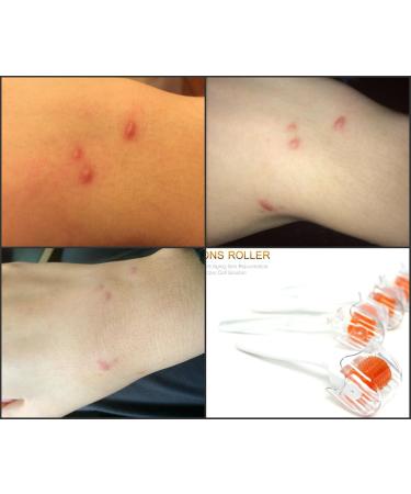 Dns Derma Skin Roller For Winkles & Scars (1.0mm) - Buy Online on GoSupps.com